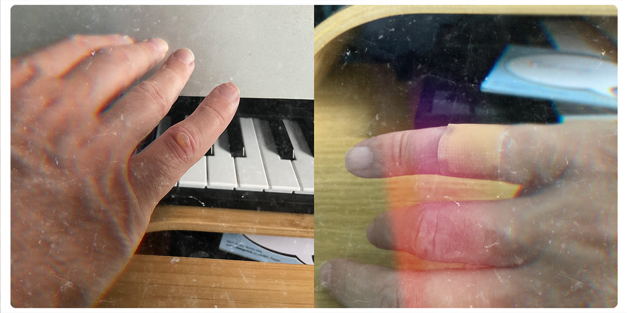 blister on my little finger coffee injury